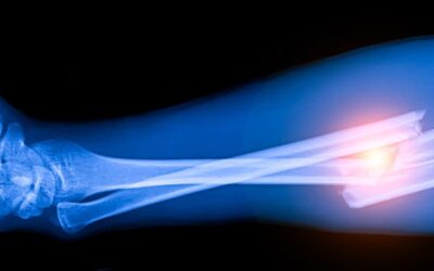 La innovación médica que está salvando extremidades en Chile